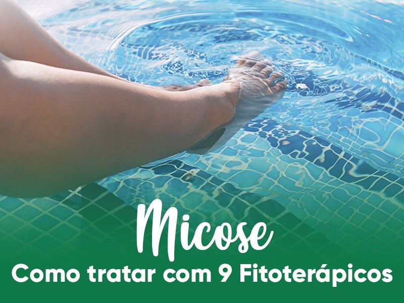 Micose: Como Tratar com 9 Fitoterpicos